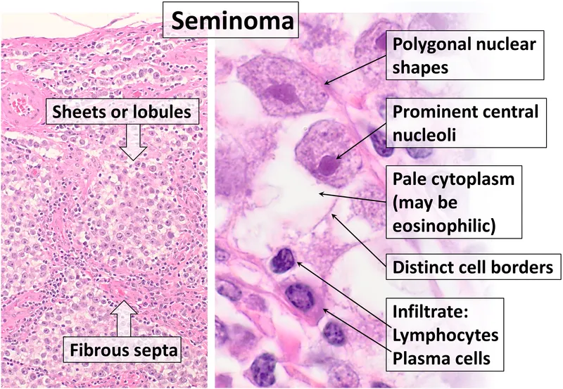 Histopathology of classic seminoma testis