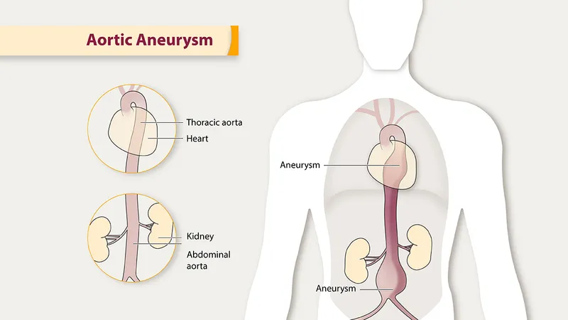 Thoracic and abdominal aortic aneurysms