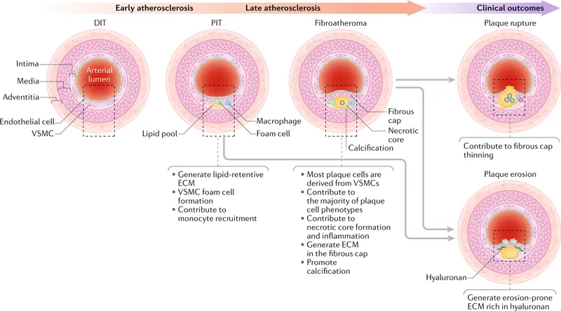Atherosclerotic plaque formation & outcomes