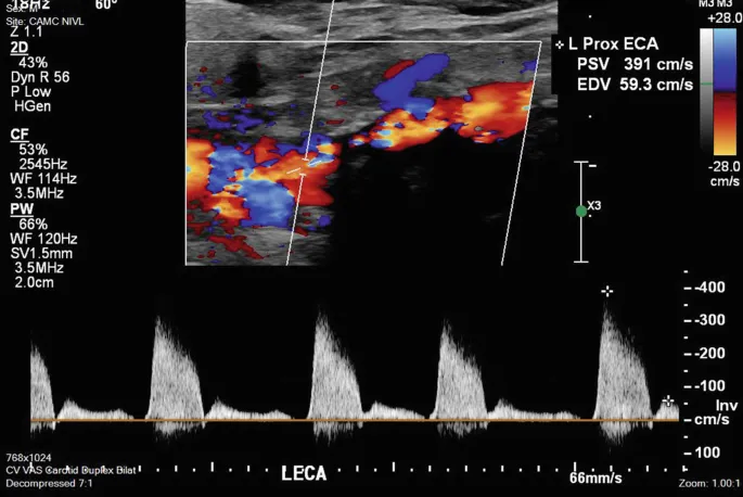 Carotid Duplex Ultrasound with Stenosis and Turbulent Flow