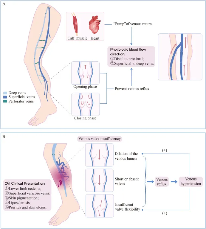 Normal vs. Insufficient Venous Valve Function in CVI