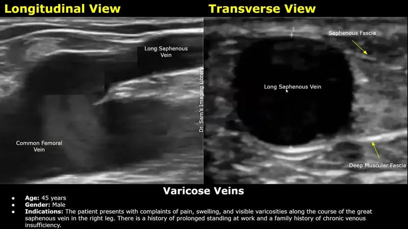Duplex Ultrasound: Long Saphenous Vein