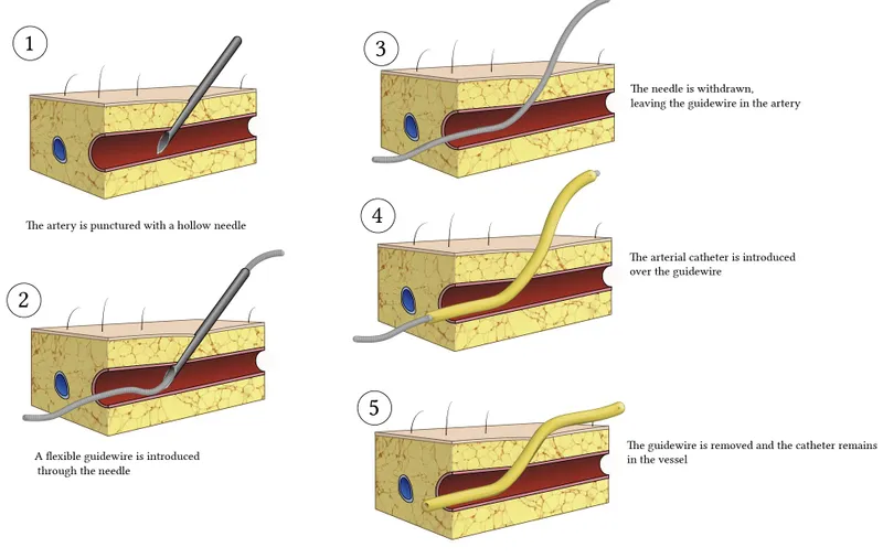 Seldinger technique steps