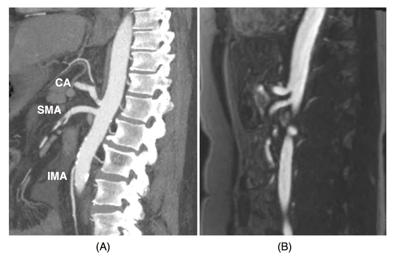 CTA and MRA of mesenteric artery stenosis