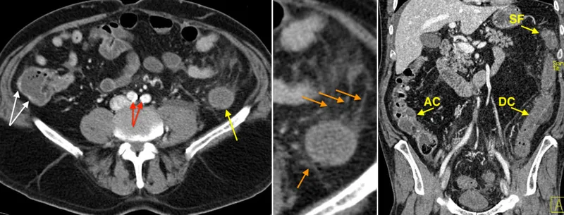 CT scan: Thumbprinting in Ischemic Colitis