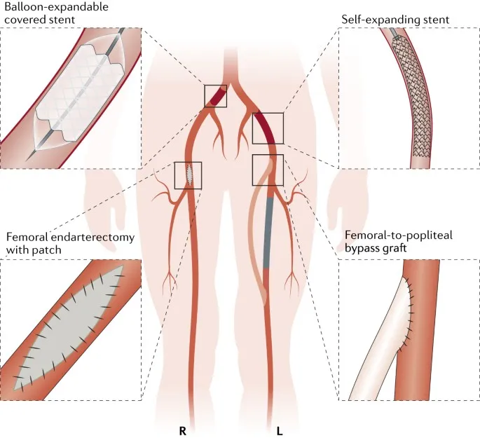 Peripheral artery revascularization options