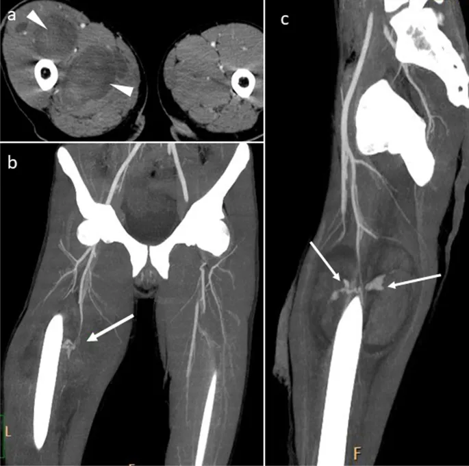 CT angiogram of lower limb vascular trauma