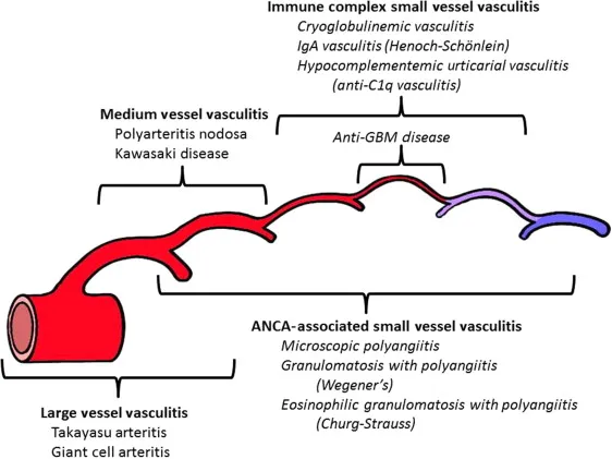 Classification of vasculitis