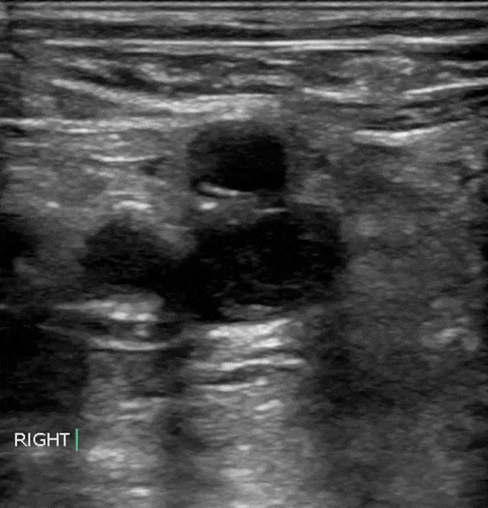 Ultrasound: DVT non-compressible vein
