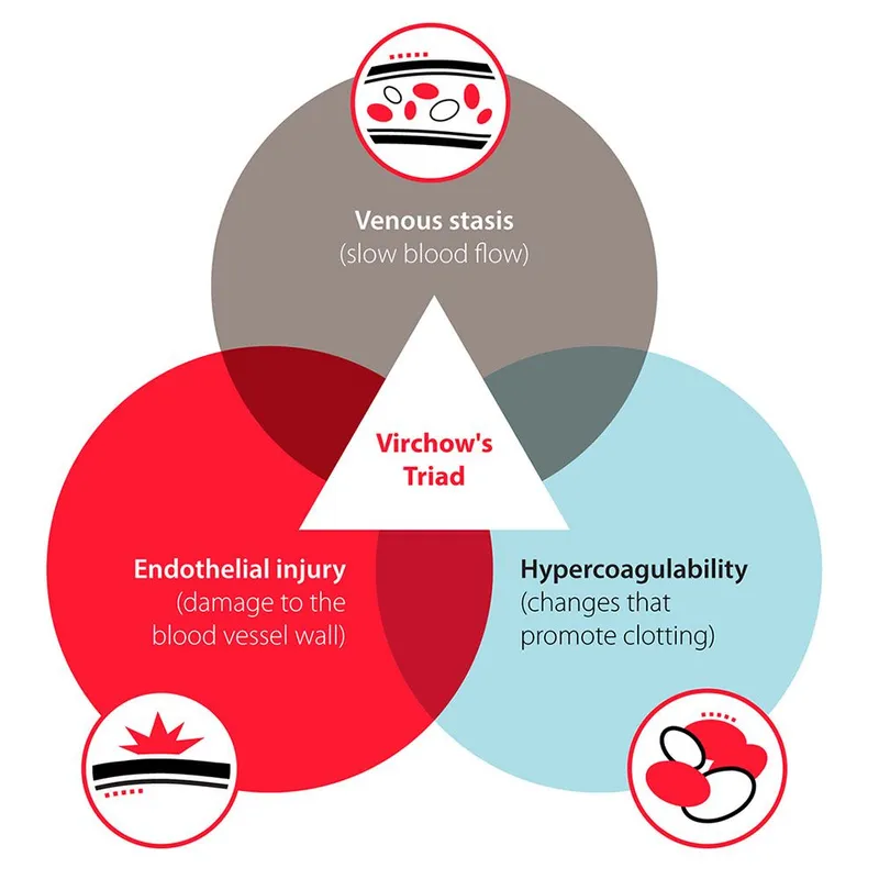 Virchow's Triad for Venous Thromboembolism