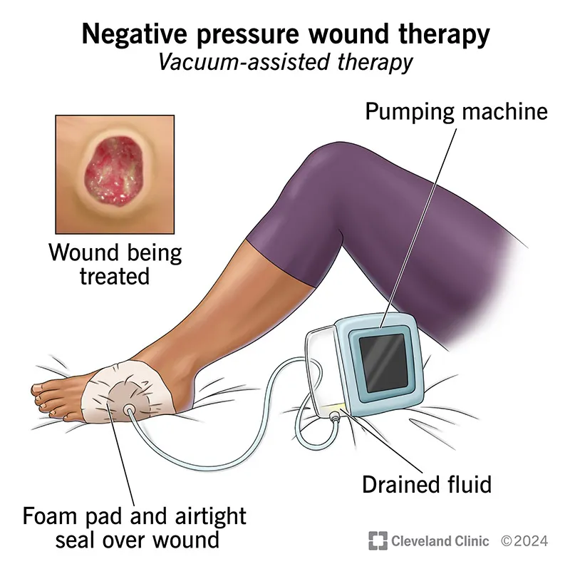 Negative Pressure Wound Therapy Device Setup