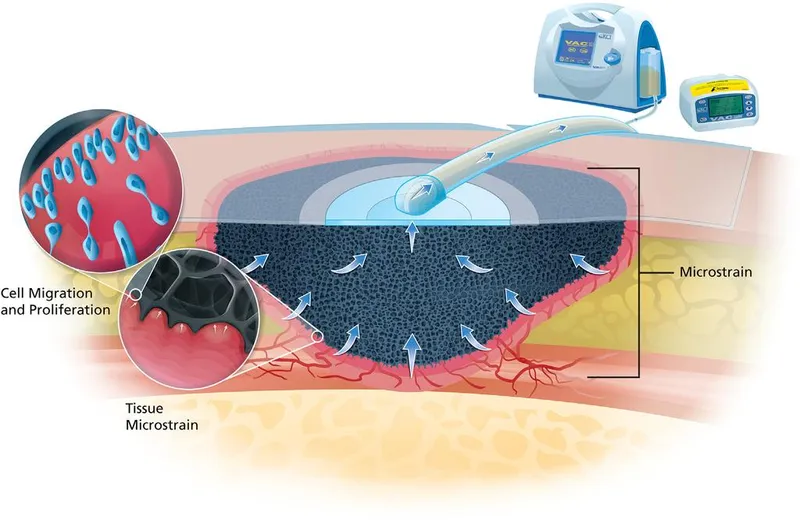 Negative Pressure Wound Therapy (NPWT) Mechanism