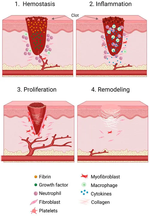 Four phases of wound healing: hemostasis to remodeling