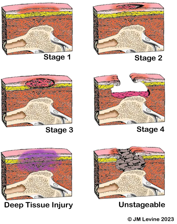 Pressure Ulcer Stages: 1, 2, 3, 4, DTI, Unstageable