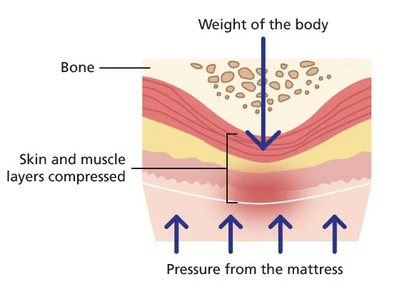 Pressure and shear forces on tissue over bony prominence