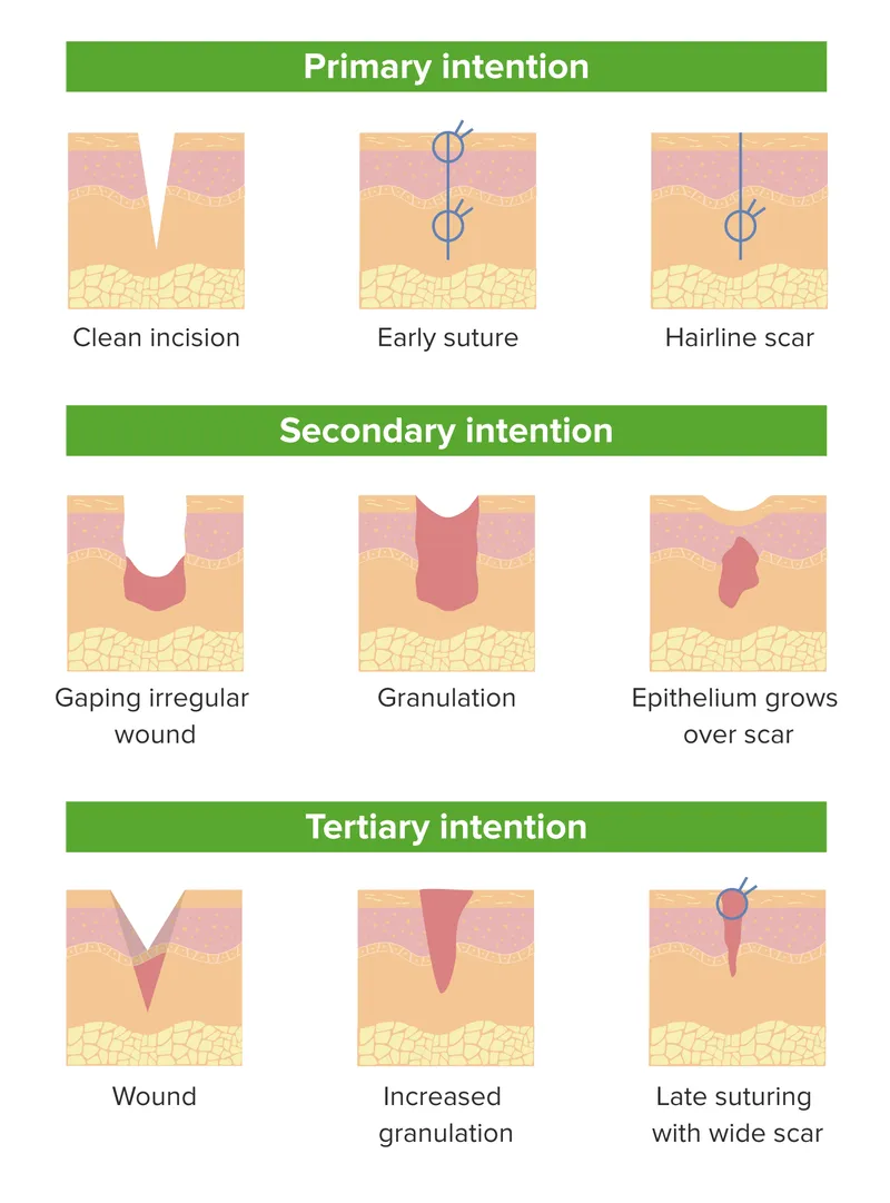 Primary, Secondary, and Tertiary Wound Healing