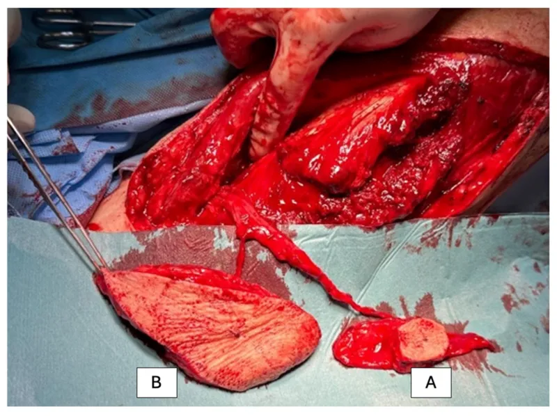 Skin graft vs. flap with vascular pedicle