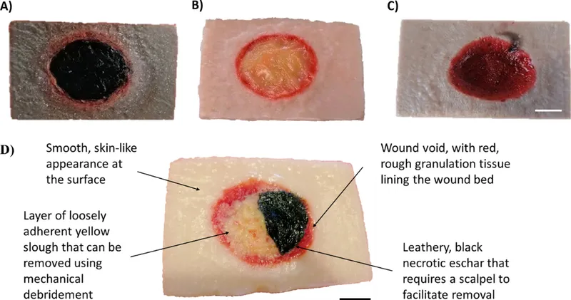 Wound bed with eschar, slough, and granulation tissue