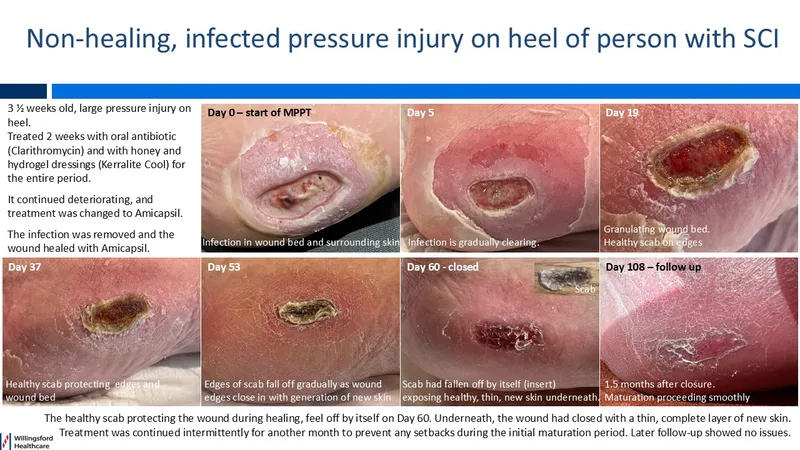 Healing of infected pressure injury on heel over 108 days