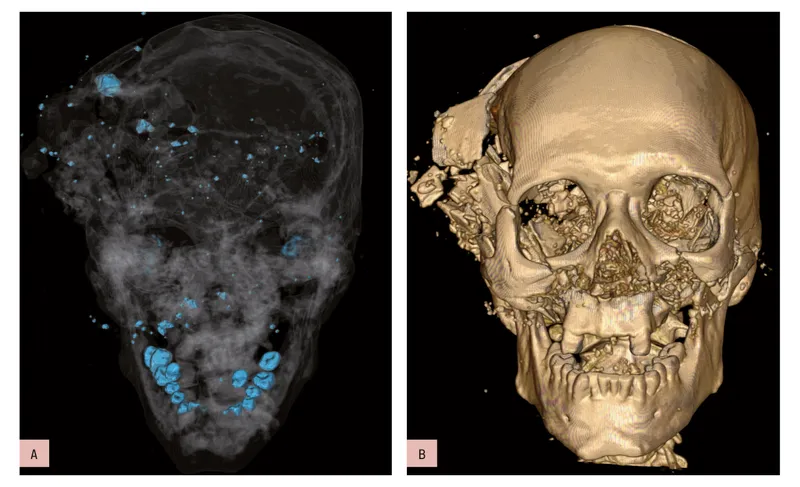 3D CT reconstruction of skull with bullet fragments