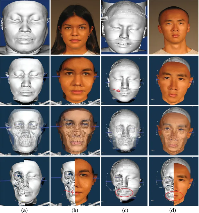 3D Craniofacial Superimposition for Forensic ID