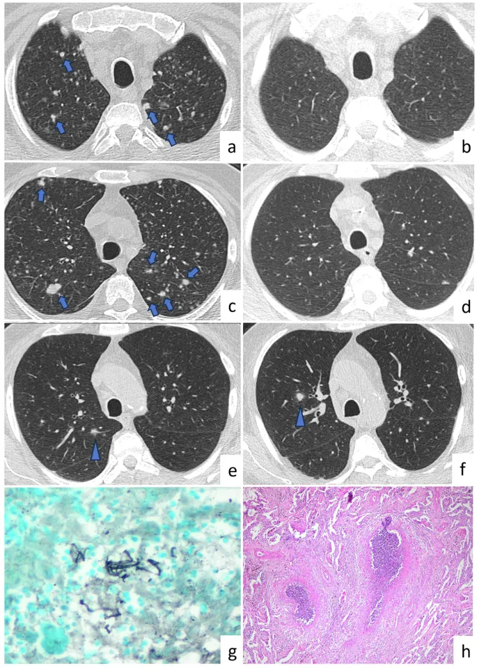 Silicosis: CT, histology, and microbiology