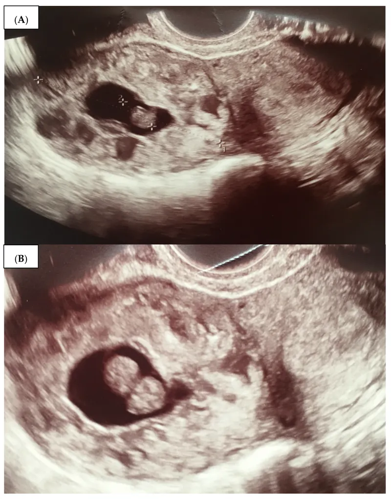 Ultrasound of early pregnancy with fetal pole and yolk sac