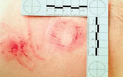 Bite mark injury with scale for forensic documentation