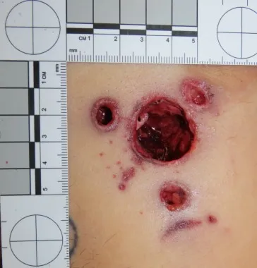 Firearm wound characteristics with satellite wounds
