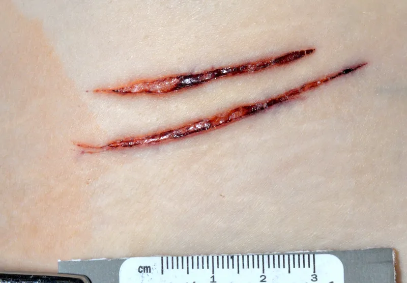 Sharp force injuries with ruler for scale