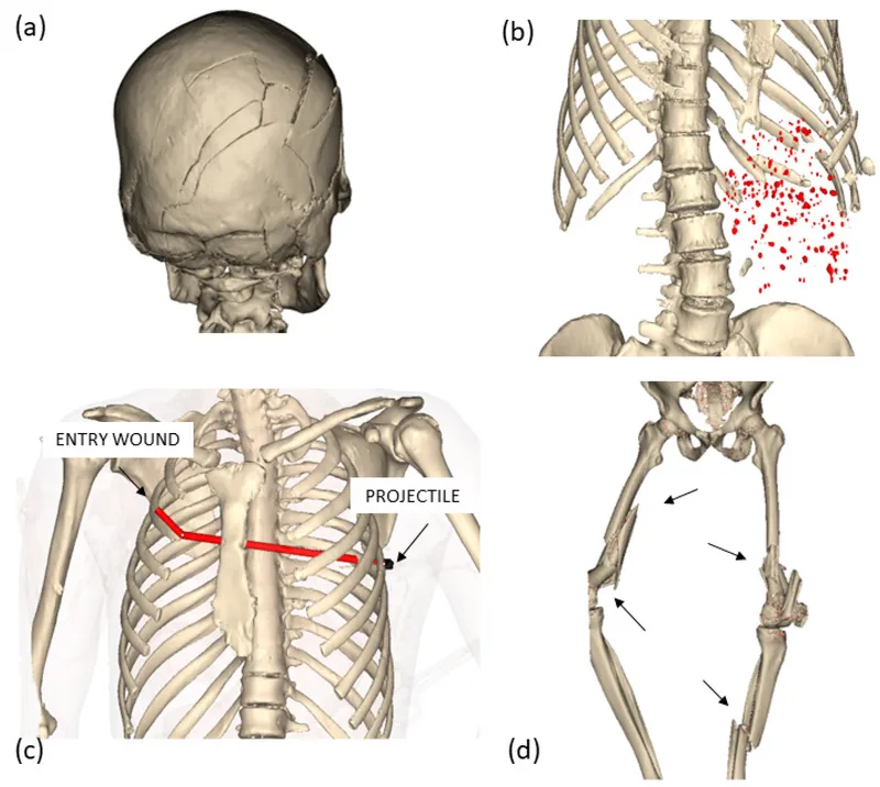 3D CT reconstruction of firearm wound trajectories