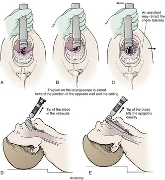 Laryngoscope insertion and epiglottis lifting technique