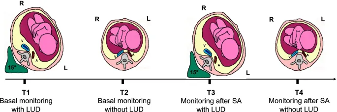 Aortocaval compression in pregnant patient with/without LUD