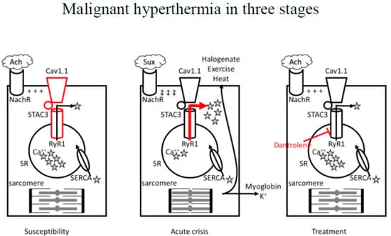 Malignant hyperthermia: susceptibility, crisis, treatment