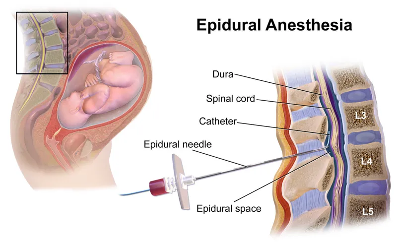 Epidural Anesthesia Needle Placement in Pregnant Patient