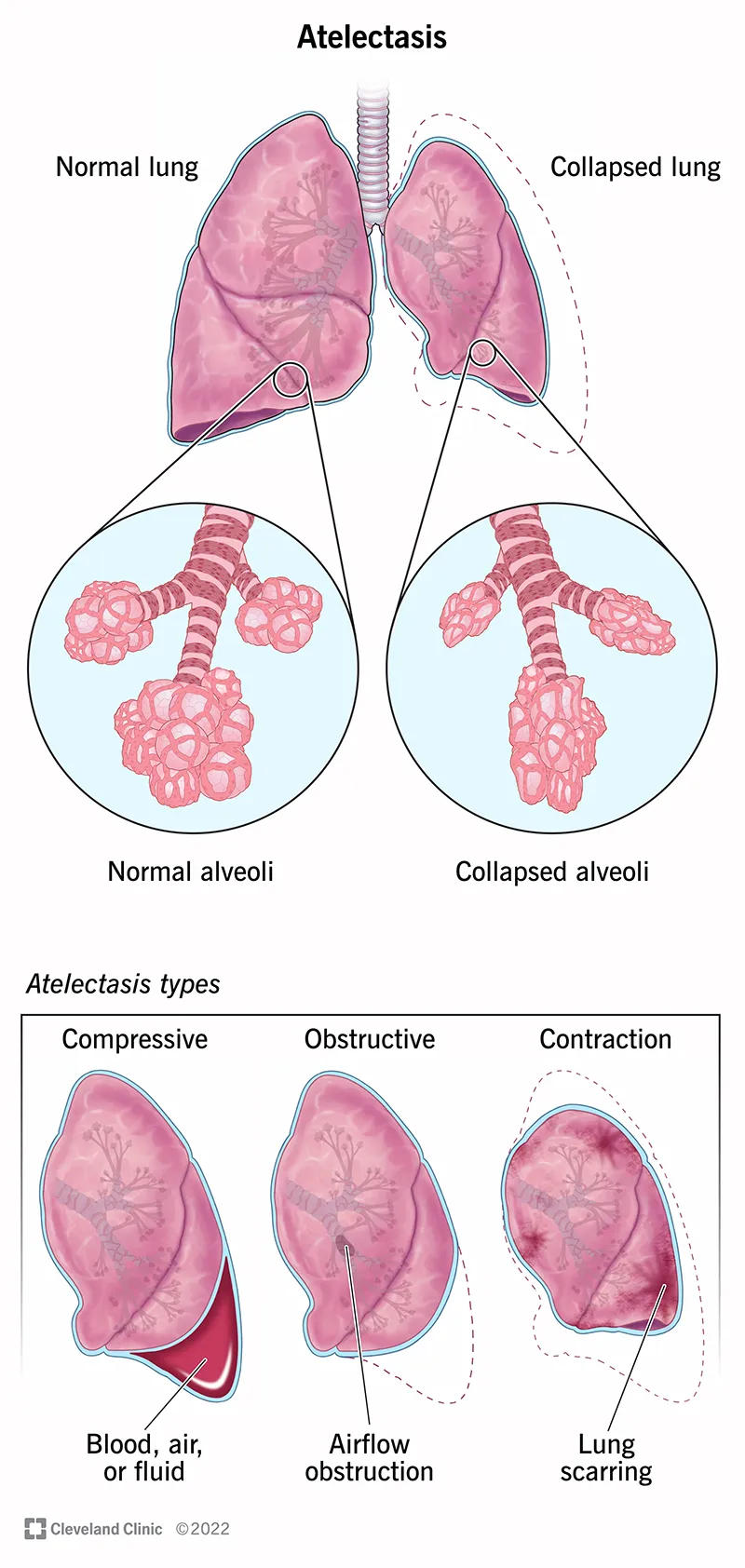 Atelectasis: Normal vs. Collapsed Lung & Types