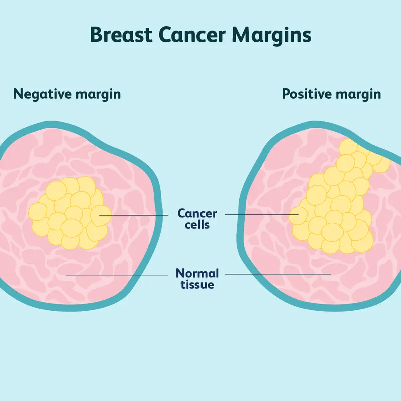 Breast Cancer Margins: Negative vs. Positive