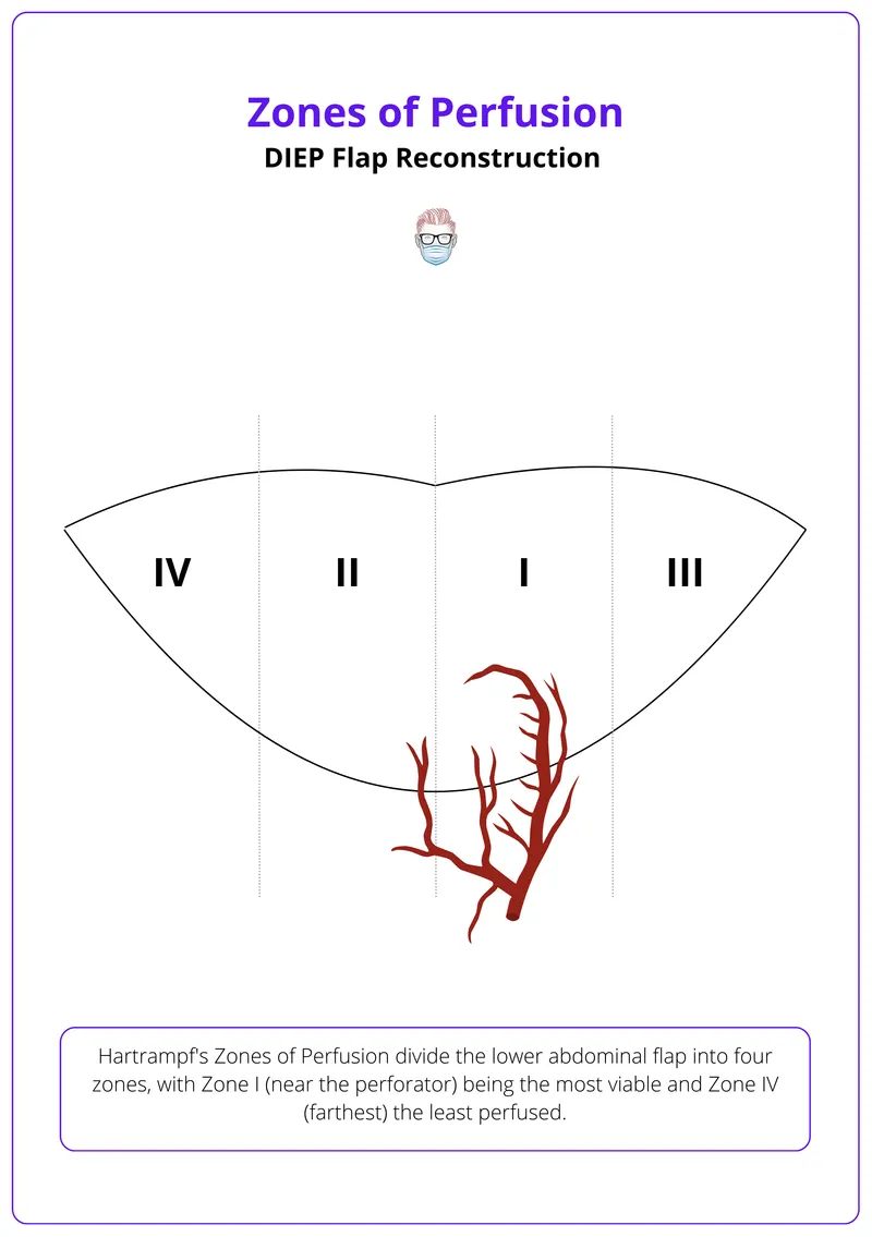 Hartrampf’s Zones of Perfusion in DIEP Flap
