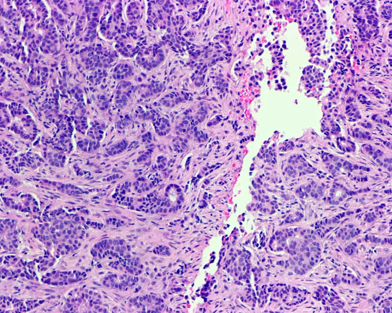 Invasive ductal carcinoma in male breast tissue (histology)