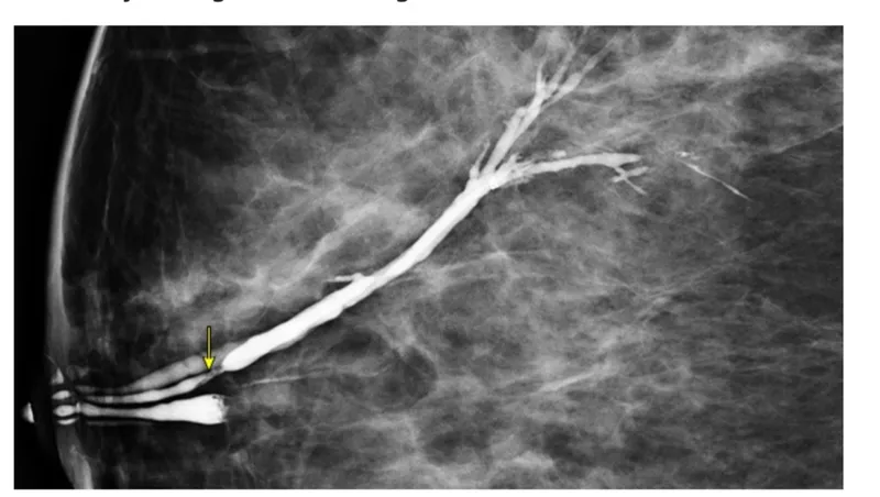 Galactogram: Intraductal papilloma filling defect