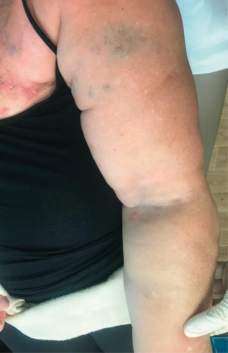Lymphedema of the arm after mastectomy