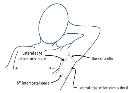 Anatomy of the safe triangle for chest tube insertion