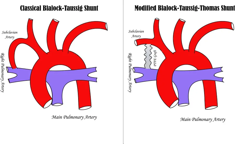 Classical vs. Modified Blalock-Taussig-Thomas Shunt