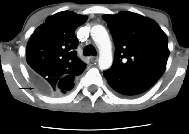 Chest CT: Loculated empyema with split pleura sign