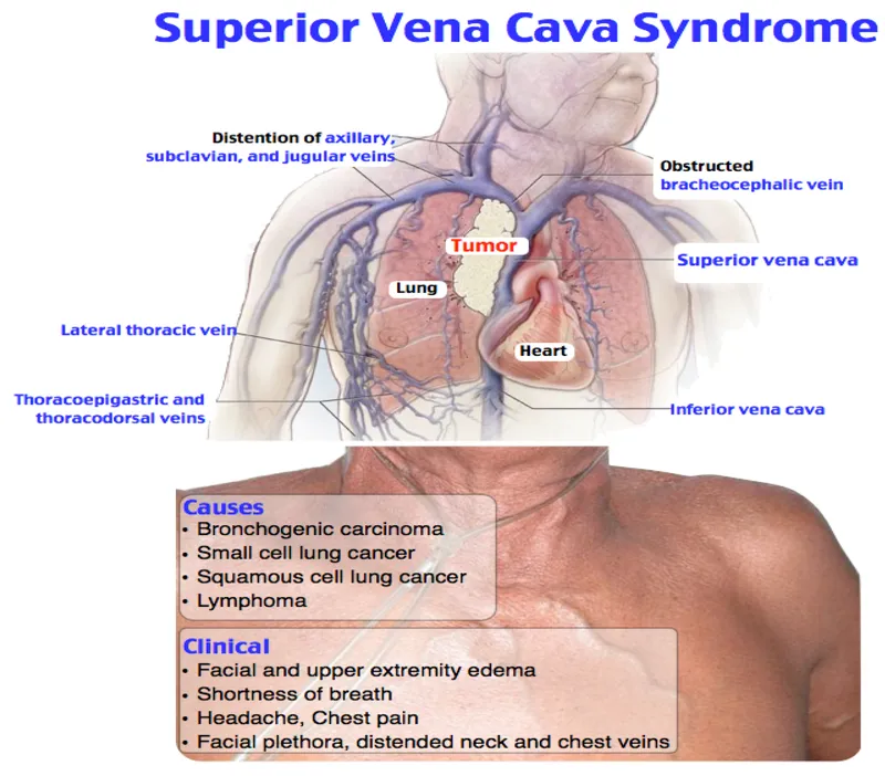 Superior Vena Cava Syndrome: Causes, Clinicals, Anatomy