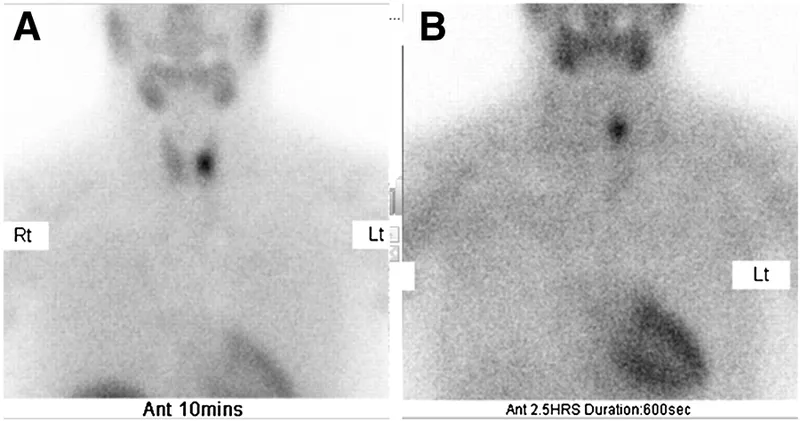 Sestamibi scan showing parathyroid adenoma