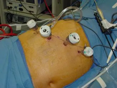 Laparoscopic adrenalectomy port placement