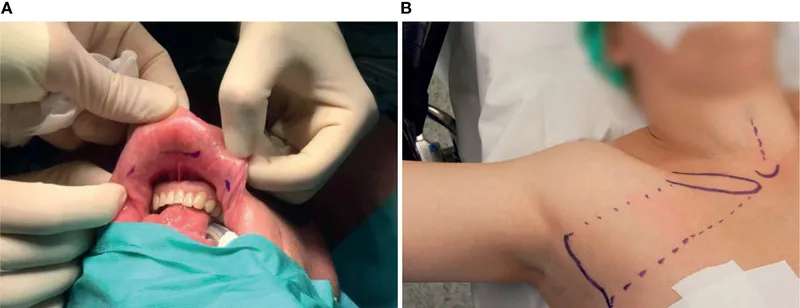 Transoral and transaxillary thyroidectomy approaches