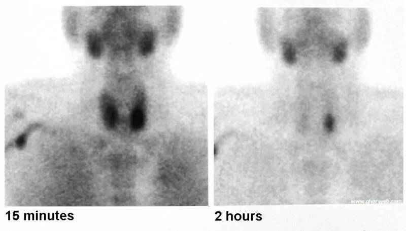 Sestamibi scan showing parathyroid adenoma