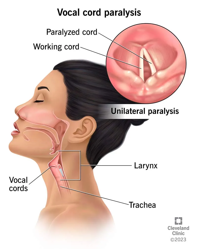 Unilateral vocal cord paralysis with anatomy